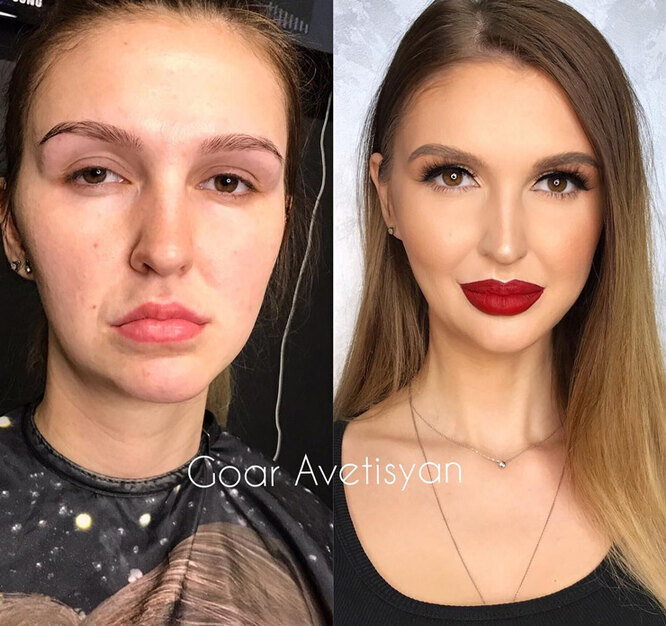 Увеличение губ канюлей filler.by