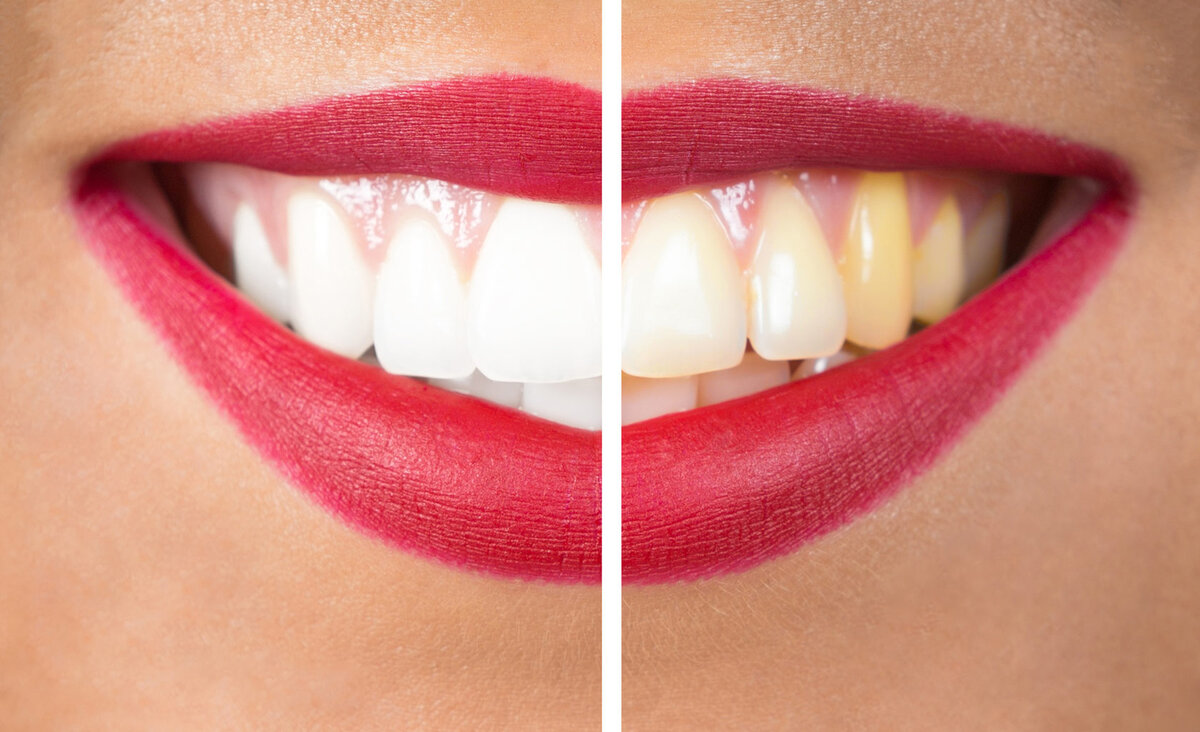 Отбеливание. Фотоотбеливание зубов. Методы отбеливания зубов. Желтые зубы, красивые белые зубы,.