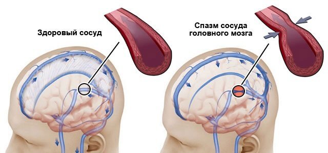 Вертеброгенная головная боль