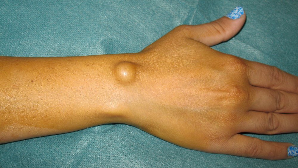 Узелки на коже - симптомы какой болезни — Клиника «Доктор рядом»