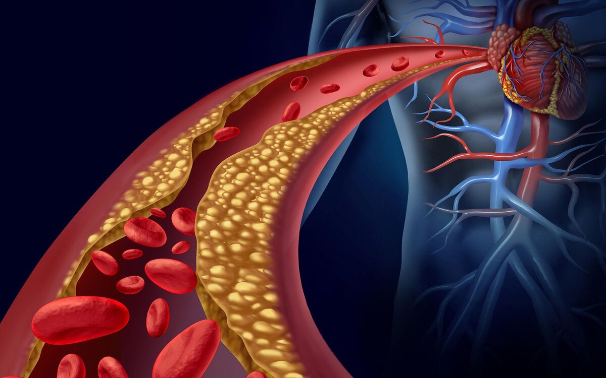 Атеросклероз - главная причина инсультов