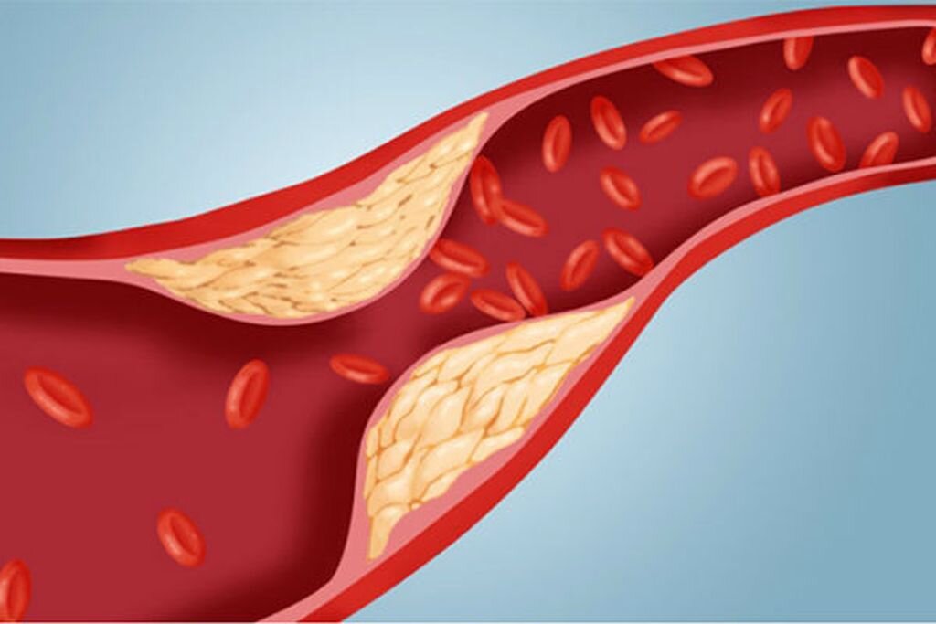 Чистка сосудов: что это, и можно ли убрать холестериновые бляшки?