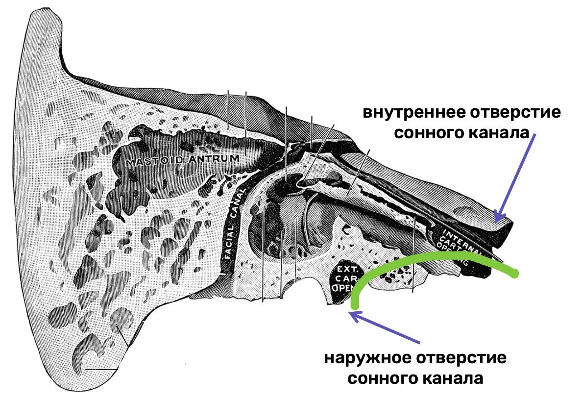 Внутренний канал. Canalis Facialis височной кости. Наружное отверстие сонного канала височной кости. Наружное и внутреннее отверстие сонного канала височной кости. Каналец барабанной струны височной кости.