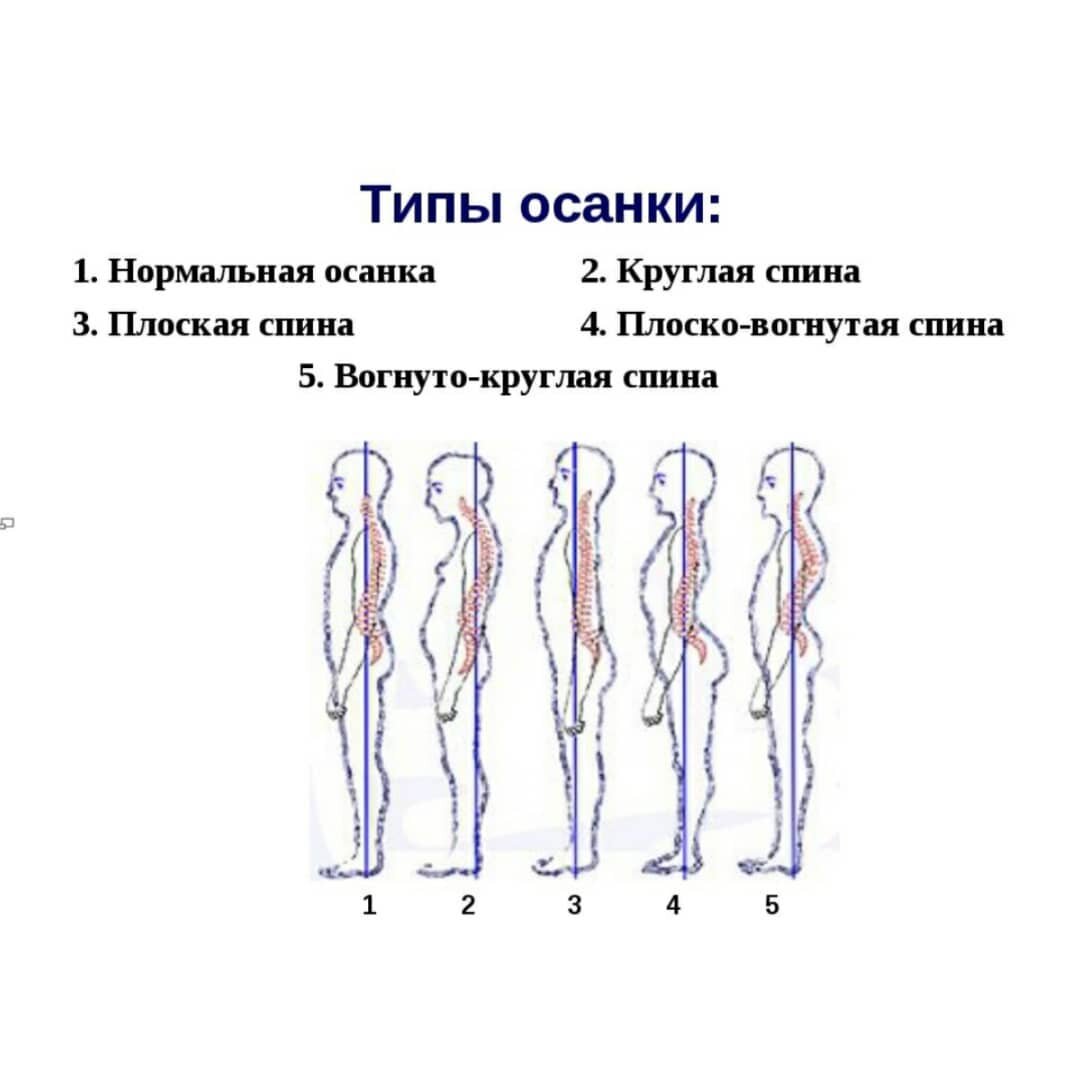 Виды осанки картинки