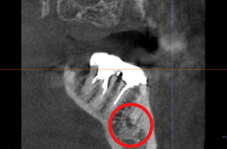 Воспаление верхушки корня зуба