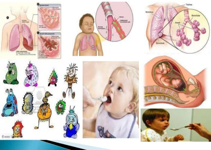 пневмония у детей картинки. пневмония у детей педиатрия. причины пневмонии у детей. воспаление легких у детей. легионеллезная пневмония рентгенограмма.