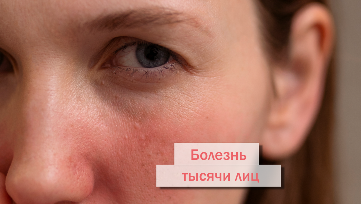 Болезнь тысячи лиц: что нужно знать о системной красной волчанке ...