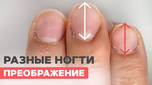 Ногти для медсестры | Исправляем разные ногти | Наращивание