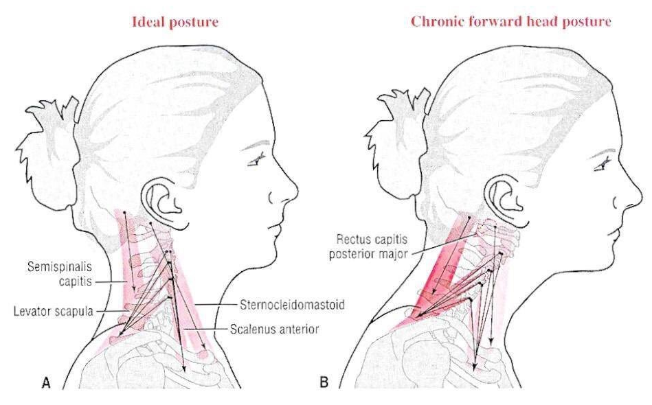 Шея вперед. Триггеры грудино-ключично-сосцевидной мышцы. Шея выдвинулась вперед. Текстовая шея.