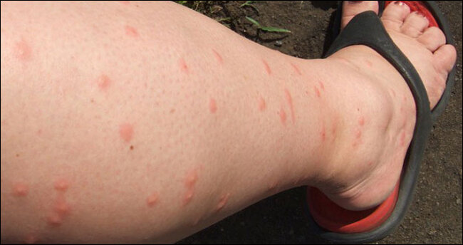 Не в то время, не в том месте. В общем, типичные последствия столкновения с ордой комаров. 