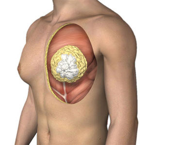 Выявление доброкачественной или злокачественной опухоли в железе или подозрение в отношении их;