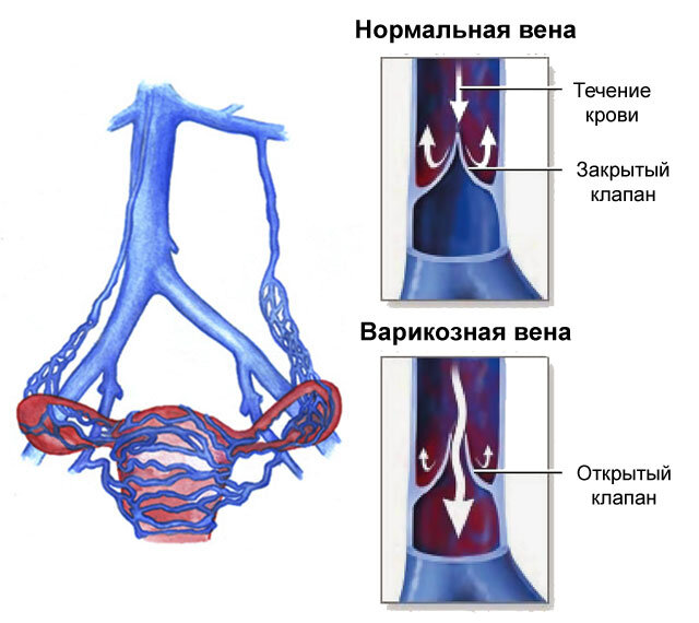 Варикозное расширение вен матки