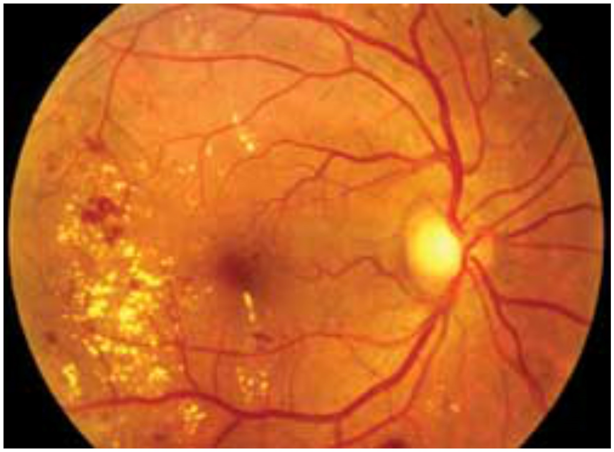 Диабетическая ретинопатия.