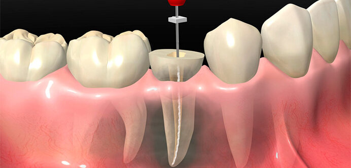 Пломбирование зубного корня