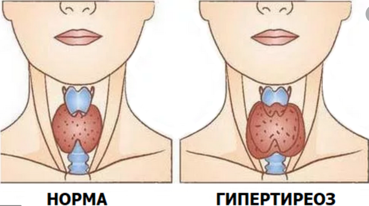 Гипертиреоз симптомы и лечение. Многоузловой гипертиреоз. Гипотиреоз щитовидной железы.