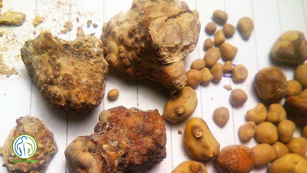 Различные конкременты