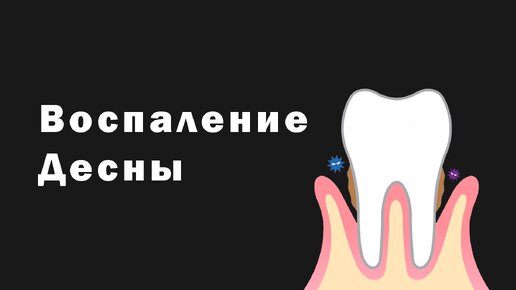 Воспаление десен. Гингивит и Пародонтит. Причины возникновения. Профилактика и лечение.