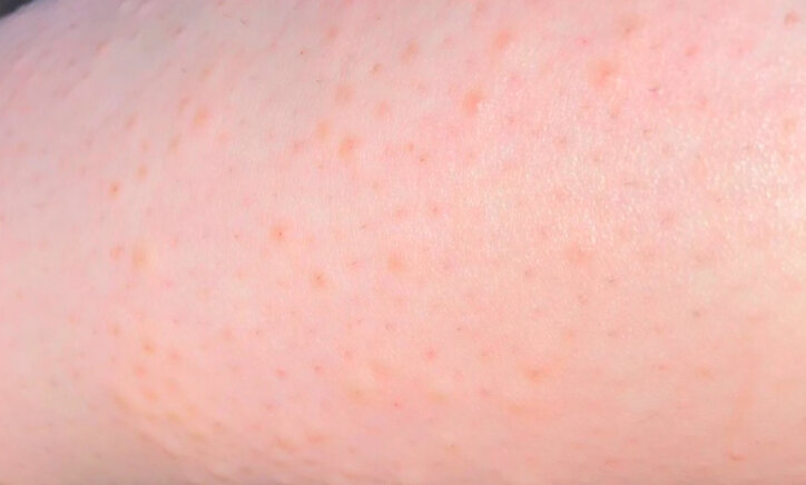 высыпания после лазерной эпиляции