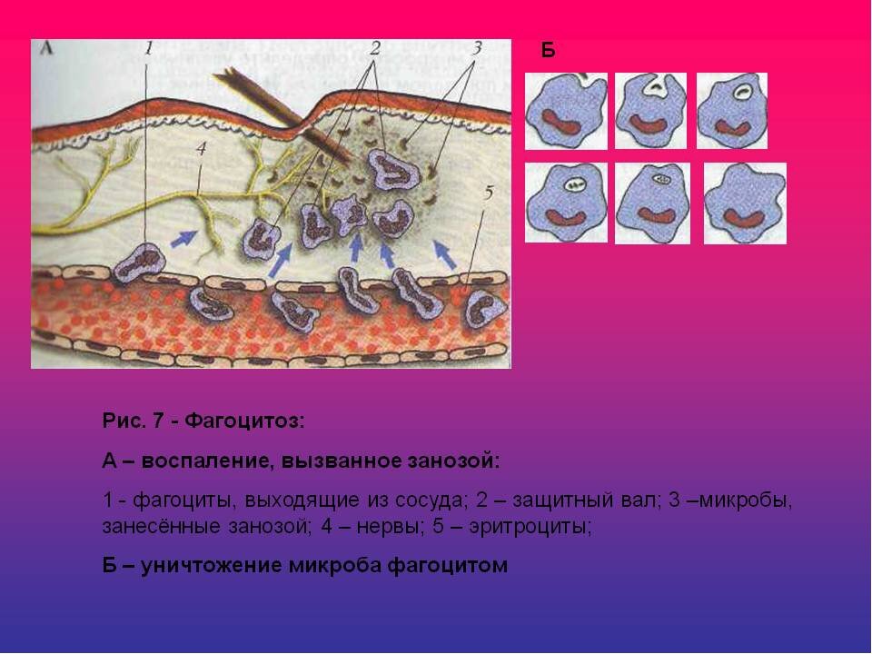 Схема воспалительного процесса. Фагоцитоз воспаление вызванное занозой. Схема воспалительного процесса вызванного занозой. Воспаление вызванное занозой рисунок. Воспалительный процесс биология.