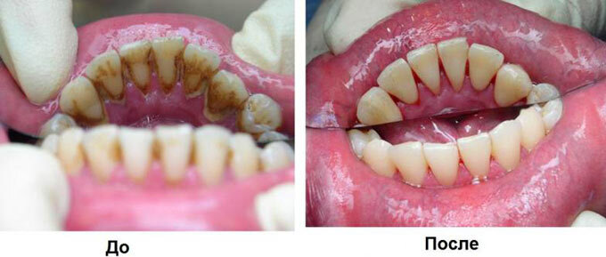   У многих людей образовываются зубные камни. Особенно часто с этой проблемой сталкиваются заядлые курильщики.