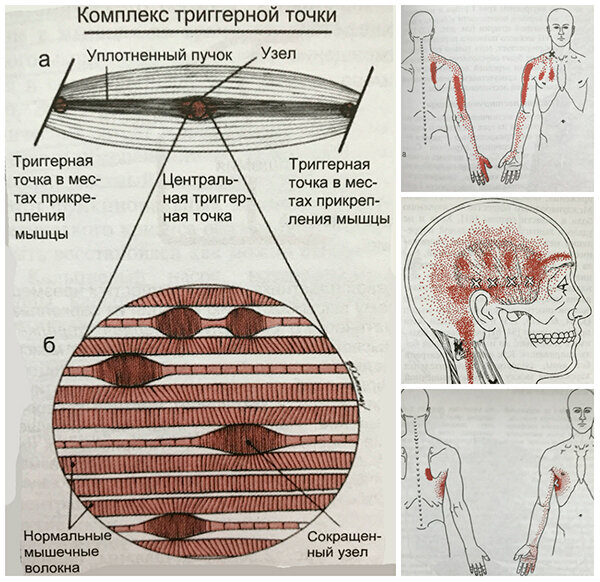 Триггерные точки на теле карта