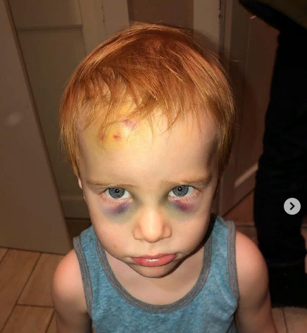 Зимой Ваня набил огромную шишку, как мы справились с этим читайте на канале. Подписывайтесь. 