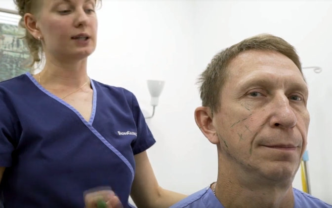 Разметка лица перед операцией. Всё реалити - по ссылке https://beautyspaceclinic.ru/realiti-ot-doktora-ross/