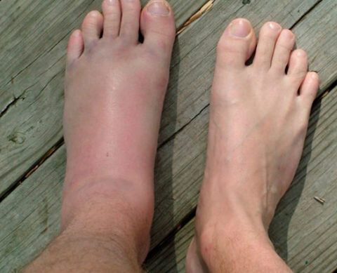  Видимая деформация стопы сразу после перелома. Обширный отек.