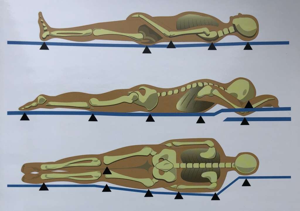 Места формирования пролежней