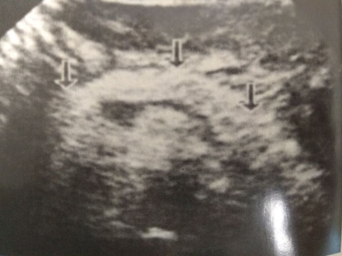 Источник: Ультрасонография органов желудочно-кишечного тракта Р.Я Аблуллаев