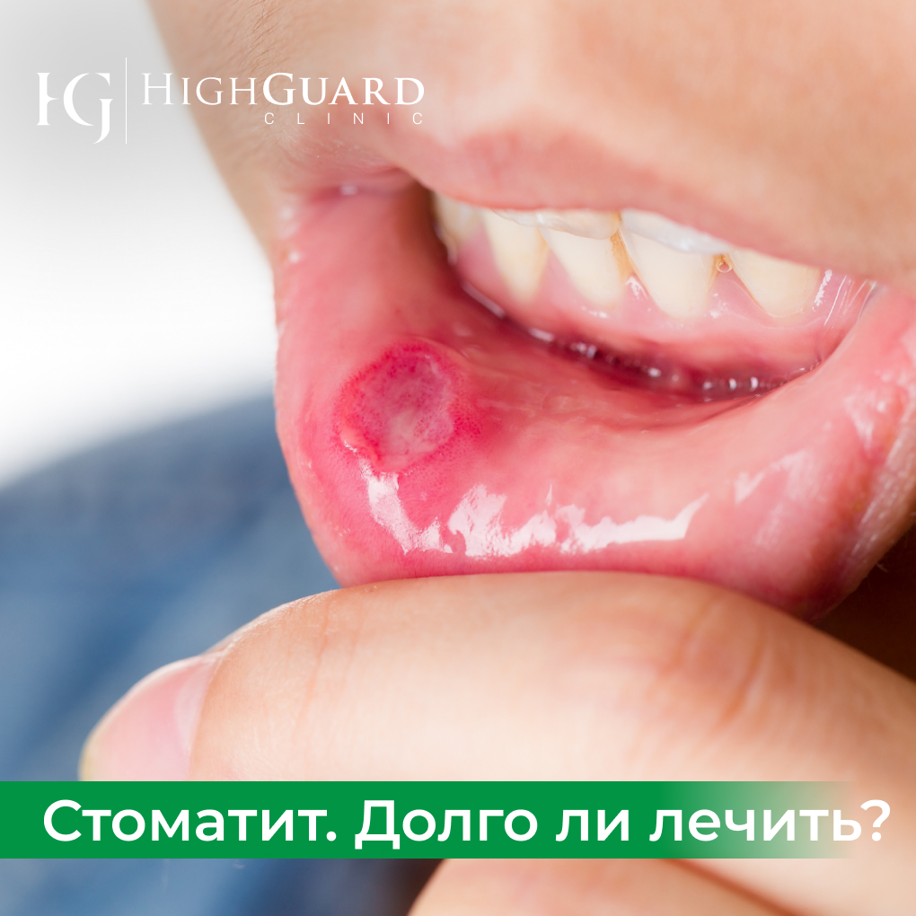 Афтозный стоматит