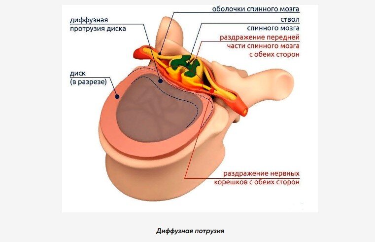 Между телами позвонков располагаются фиброзно-хрящевые образования – позвоночные диски, которые имеют амортизирующую функцию.