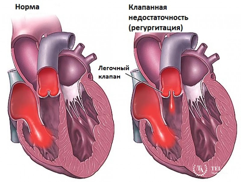 Клапанные патологии сердца