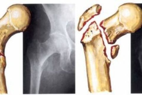  Чтобы оценить степень серьезности полученной травмы необходимо сделать рентгенологические снимки.