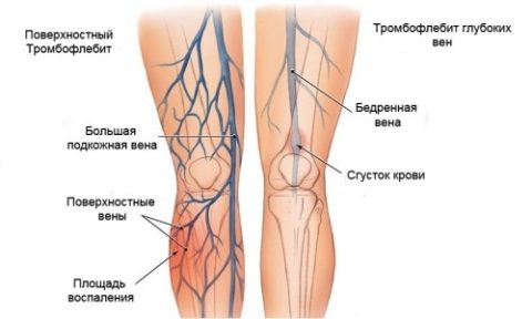  Пример развития острого тромбофлебита