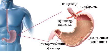 Эзофагит (K20)