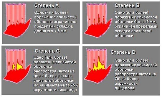 Причины эрозивного эзофагита, симптомы, факторы риска