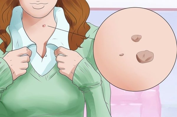 родинка, удаление родинок, родинки на теле, родинки на лице, папилломы, бородавки, удаление папилломы, избавиться от бородавки, папилломы на шее