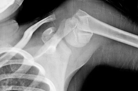  Проксимальный.