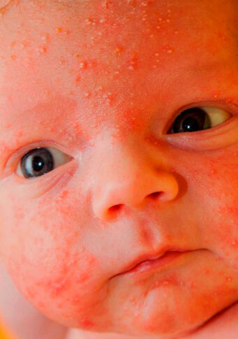 Ребенок сыпь