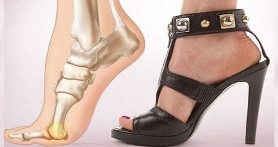Эксперты считают, что частое ношение обуви на высоком каблуке является причиной развития деформации стопы