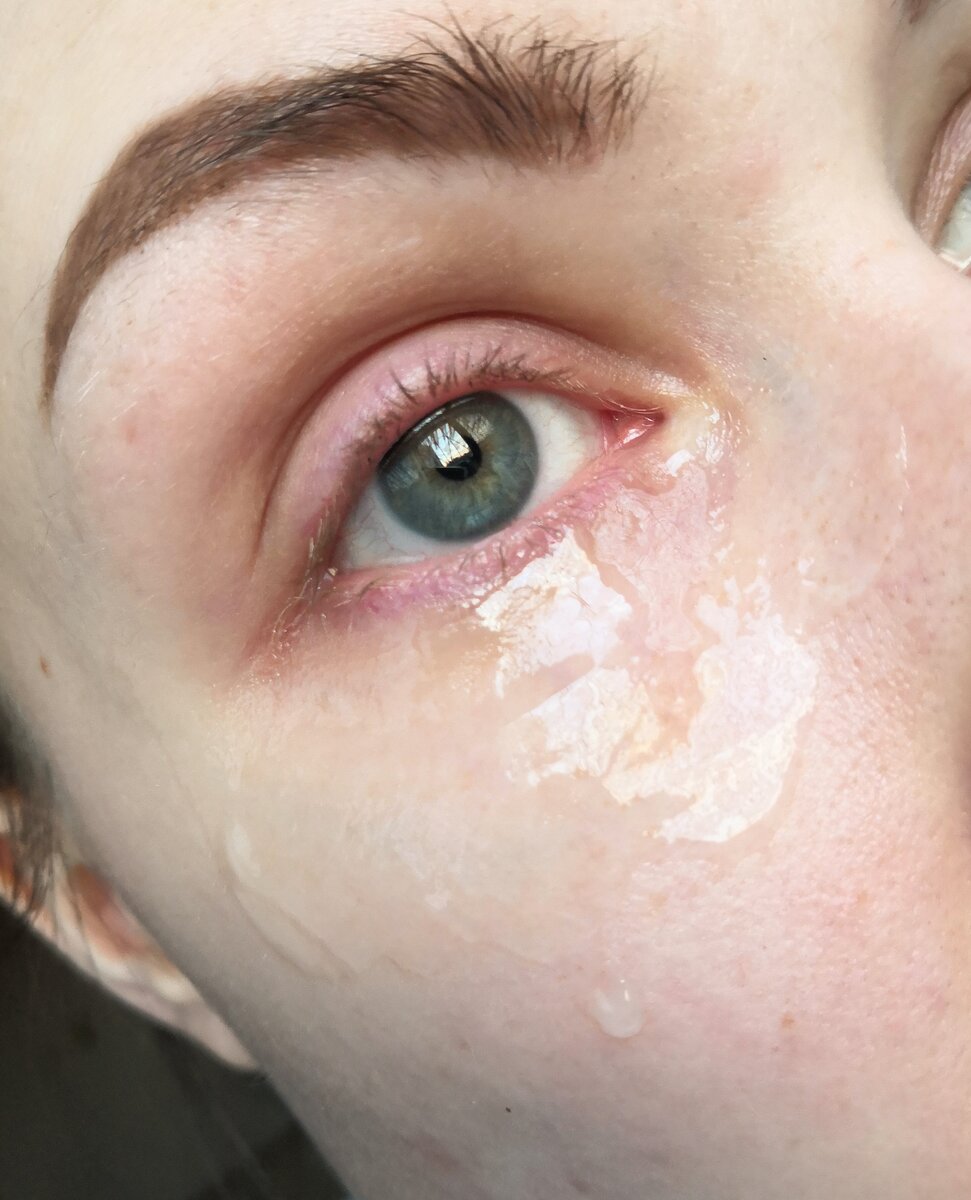 Патчи щипят под глазами. Маска под глаза от мешков. Патчи для глаз. Патчи щипят под глазами. Маска вокруг глаз.