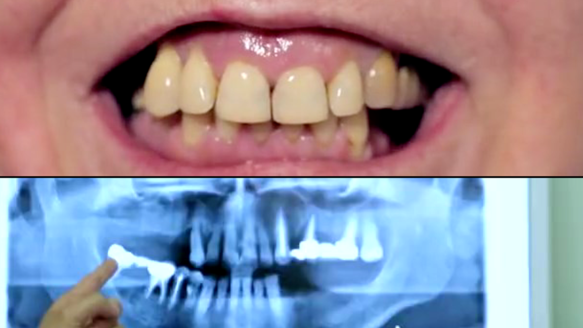 Зубы Ксении Стриж ДО работы стоматолога. Фото: кадр программы "На 10 лет моложе. Выпуск от 30.07.2016»
