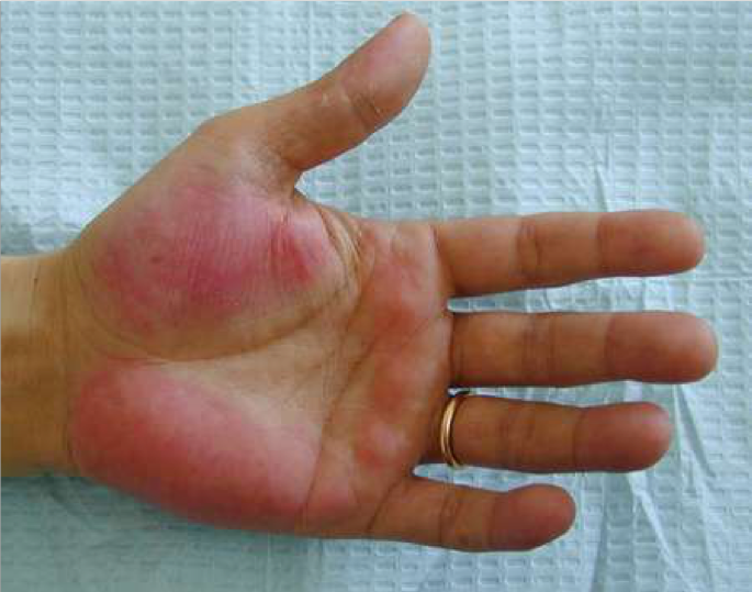 Печеночные ладони или пальмарная эритема 