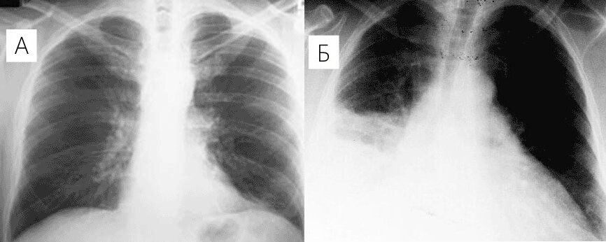 Рентгеновские снимки. А - здоровые легкие; Б - легкие с воспалением (на снимке четко видно пятно).