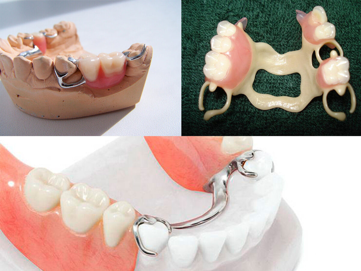 Частично зубы какой протез поставить лучше. Частично зубы какой протез поставить лучше. Полносъемные протезы ортопедическая стоматология. Съемный мостовидный протез. Частичный съемный протез flexi n512.