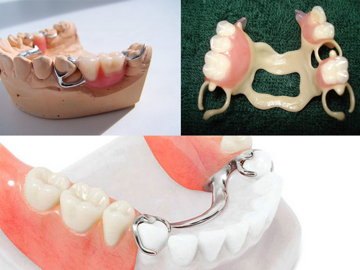 Лучшие для частичного протеза. Бюгельный протез Квадротти. Бюгельный протез (1 челюсть)+кламмер. Бюгельный протез 1эзуб. Съемный протез Квадротти.