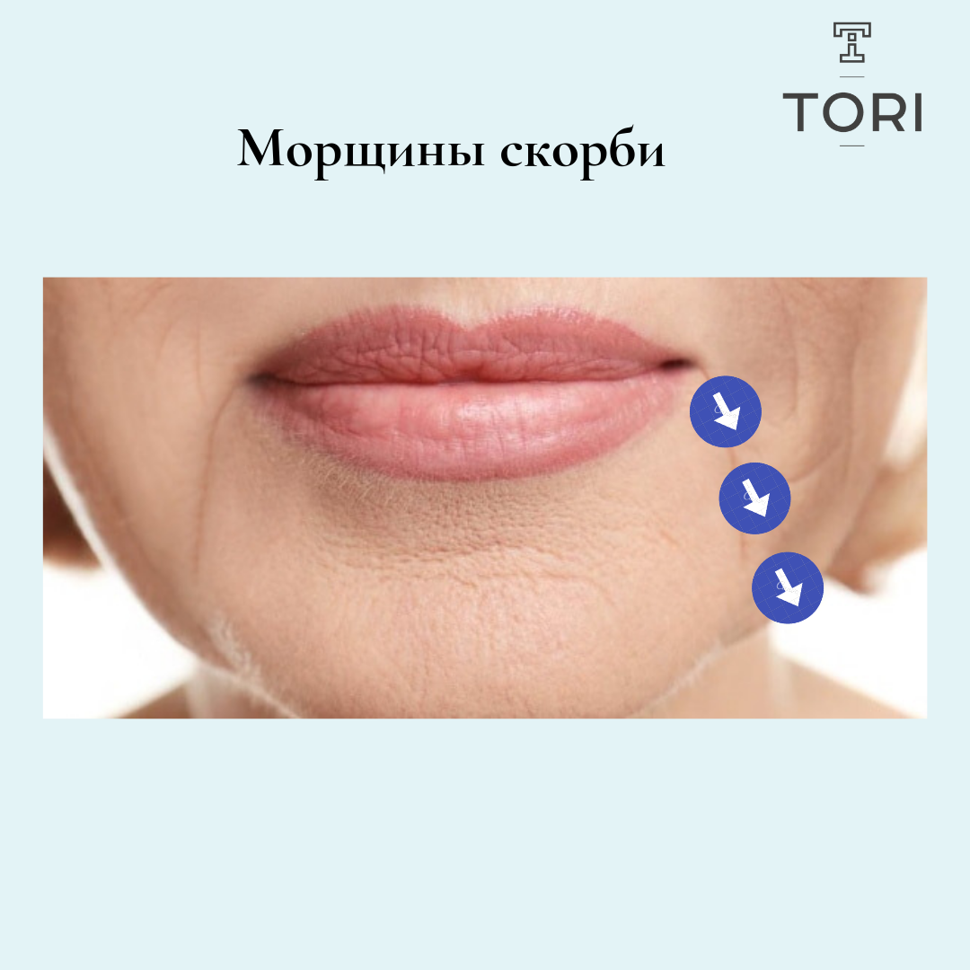 Морщины марионетки фото. Морщины на лице. Морщины марионетки макияж. Марионеточные складки. Гиперкоррекция морщин марионеток.