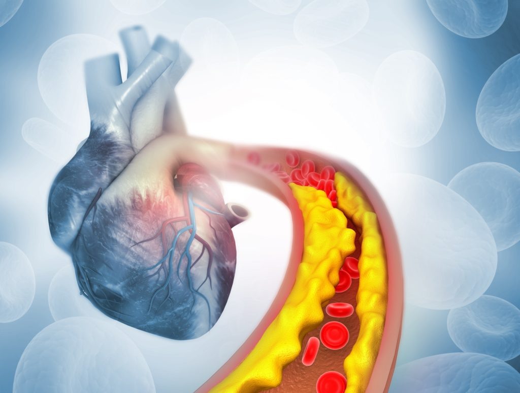 Взято с сайта https://www.demans-rehberim.com/2020/02/29/ateroskleroz/