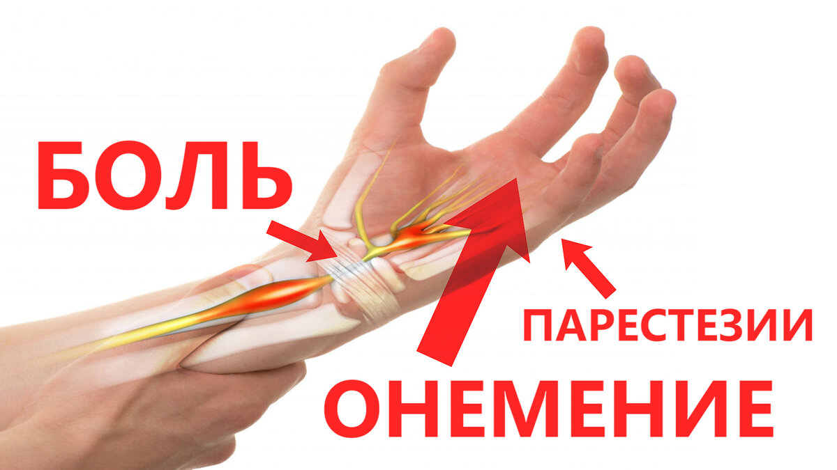 Сильно немеют пальцы на руках. Воспаление сухожилия на руке. Немеют руки. Блокада карпального канала. Синдром карпального канала.